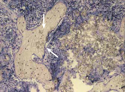 Histologischer Schnitt: PORESORB-TCP im Resorptionsverlauf